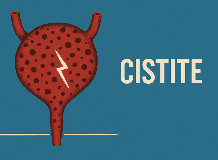 cistite