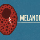 Melanoma