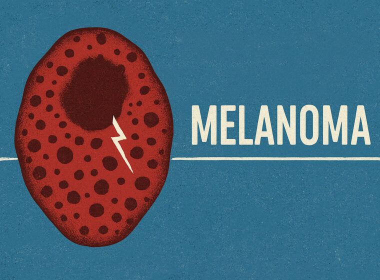 melanoma